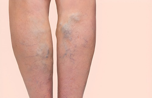 Best Vericose veins Doctor in Ranebennur